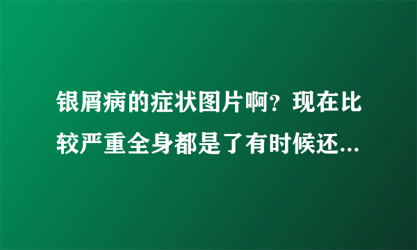 银屑病的症状图片啊？现在比较严重全身都是了有时候还发痒十分痛苦