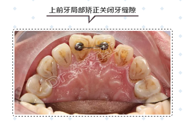 牙缝太大,如何修复?