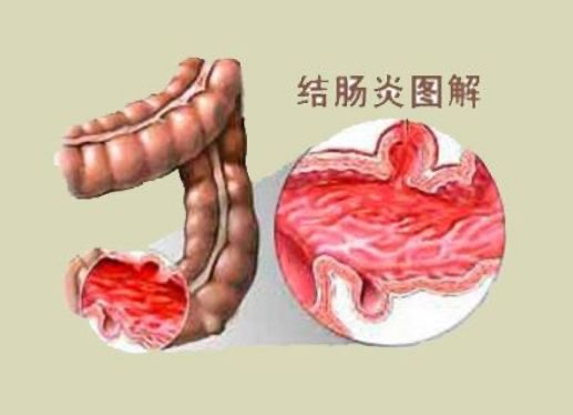 结肠炎有哪些症状？