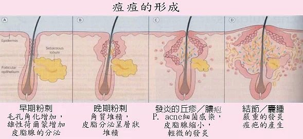 求指导，长痘的原因及调理方法？