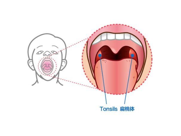 扁桃体发炎怎么办?有什么解决的办法吗？