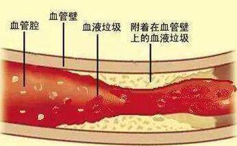 什么是动脉粥样硬化，指数的正常值是多少，高或低有什...