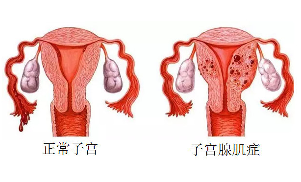 腺肌症是什么病？