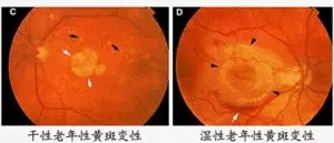 什么是眼黄斑变性？