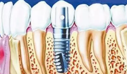 种植牙的价格一般都是多少钱?