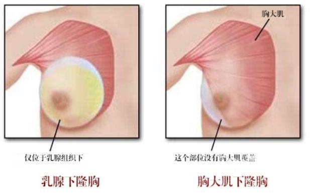 假体隆胸能保持多久