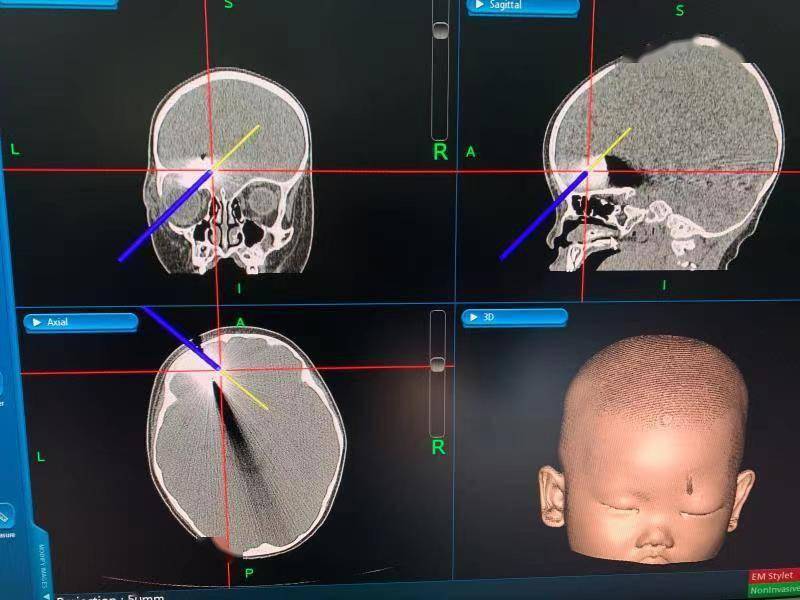 上海专家从女婴颅内取出4厘米断刀，它是如何进入颅内的？