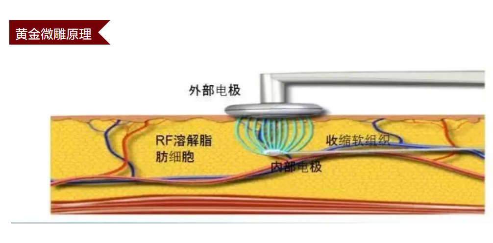 面部黄金微雕是什么