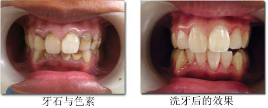 正规医院洗牙多少钱啊？