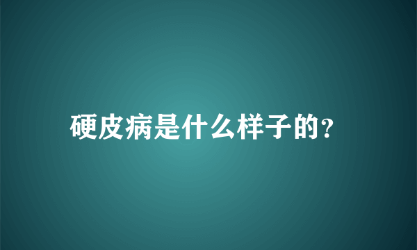 硬皮病是什么样子的？